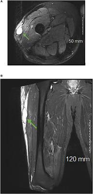 Outcomes and complications of postoperative seroma cavities following soft-tissue sarcoma resection